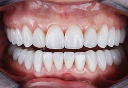 beautiful teeth with ceramic veneers of the patient's upper and lower jaws